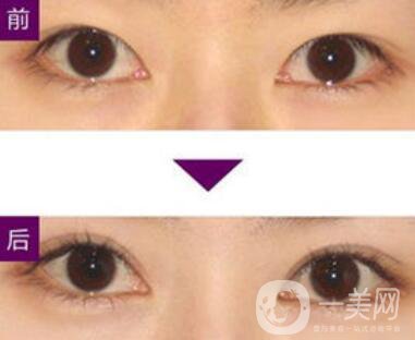 三點(diǎn)定位雙眼皮手術(shù)有副作用嗎、*果怎么樣