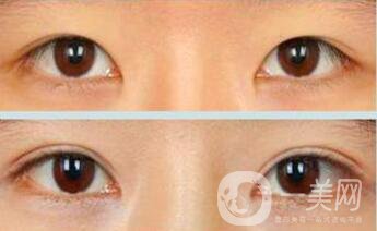 三點(diǎn)定位雙眼皮手術(shù)有副作用嗎、*果怎么樣