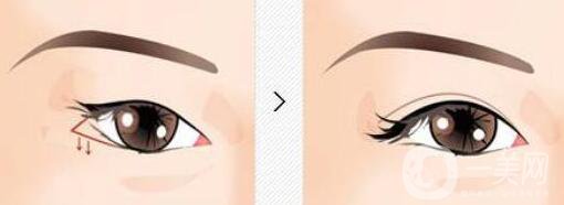 眼瞼下至老了會怎么樣？眼瞼下至多少錢