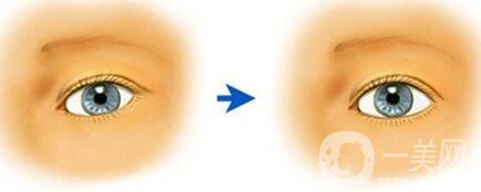 眼瞼下至老了會怎么樣？眼瞼下至多少錢