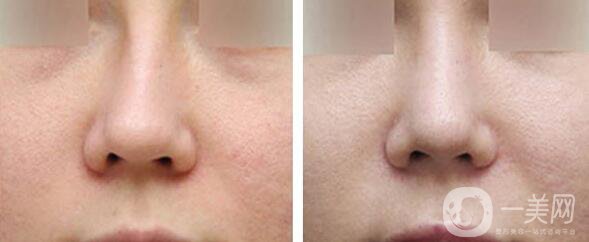 矯正鼻子大概多少錢？矯正鼻子多少費(fèi)用詳情