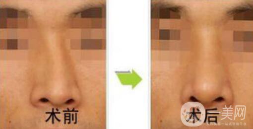 矯正鼻子大概多少錢？矯正鼻子多少費(fèi)用詳情