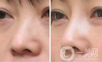 上海縮小鼻頭手術(shù)多少錢(qián) 縮小鼻頭整形價(jià)格介紹