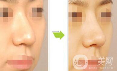 上海縮小鼻頭手術(shù)多少錢(qián) 縮小鼻頭整形價(jià)格介紹