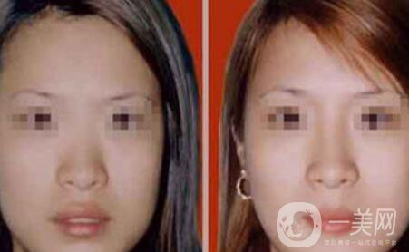 注射隆鼻一般多少錢？廣東隆鼻注射價格介紹