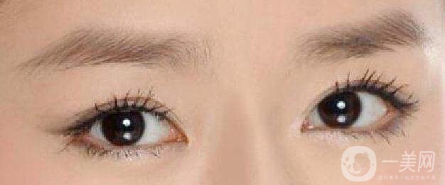 成都,割雙眼皮,多少錢