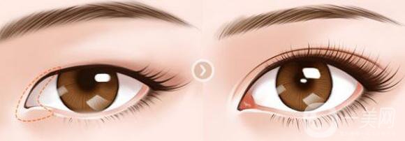 韓式開眼角多少錢 韓式*開眼角價格詳解