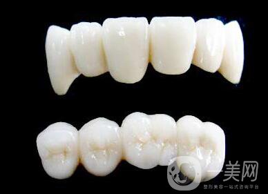 烤瓷牙能用多長時間？烤瓷牙的壽命有多長