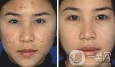 像素激光去痘多久才會(huì)好 祛痘對(duì)*果