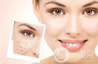 像素激光去痘多久才會(huì)好 祛痘對(duì)*果