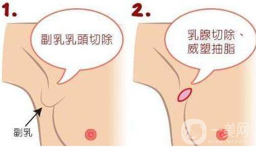 副乳吸脂,多久消腫
