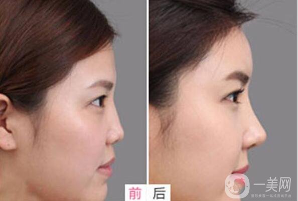 *,術(shù)后注意事項(xiàng)