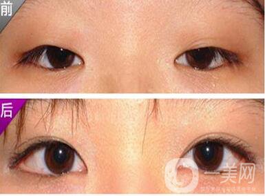 割雙眼皮,開眼角,價格