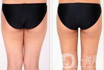 深圳,臀部抽脂,多少錢 