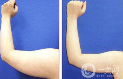 廣東,手臂吸脂,多少錢 