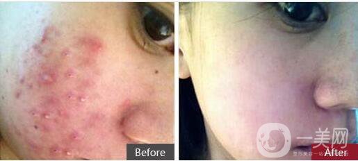 復(fù)合彩光祛痘,多少錢