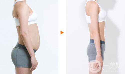 上海360度吸脂多少錢 360度吸脂價格詳解