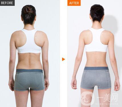 上海360度吸脂多少錢 360度吸脂價格詳解