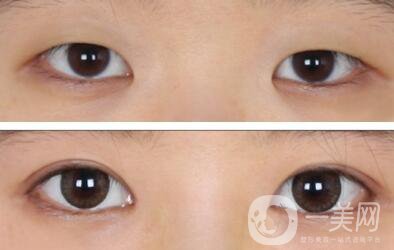 開眼角哪*果好  開眼角哪家醫(yī)院比較好