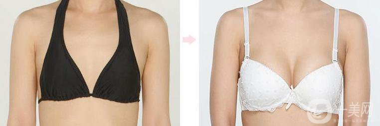 假體隆胸多久可以抽煙 注意事項