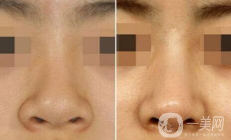 深圳鼻翼縮小多少錢能做 鼻翼縮小手術價格詳解