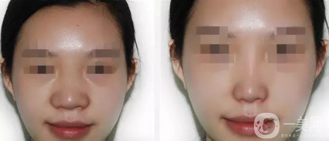 鼻翼縮小價錢 參考價格詳情