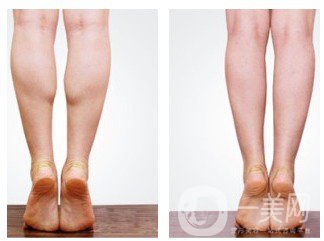 *瘦小腿價(jià)格 費(fèi)用是多少？