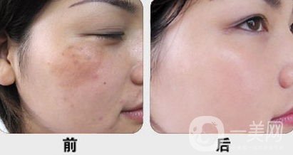 黃褐斑怎么形成的 怎么去除？