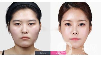 雙眼皮眼部提肌的危害有哪些？