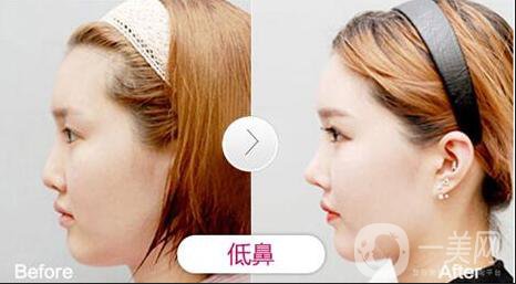 *術(shù)后1-7天的反應 *術(shù)后怎么護理