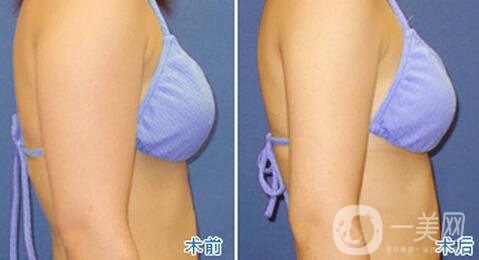 北京手臂吸脂價(jià)位是多少 手臂吸脂貴嗎