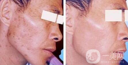 出現(xiàn)老年斑怎么辦 去掉老年斑的方法介紹