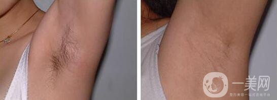 激光脫毛大概多少錢(qián) 激光脫毛具體價(jià)格