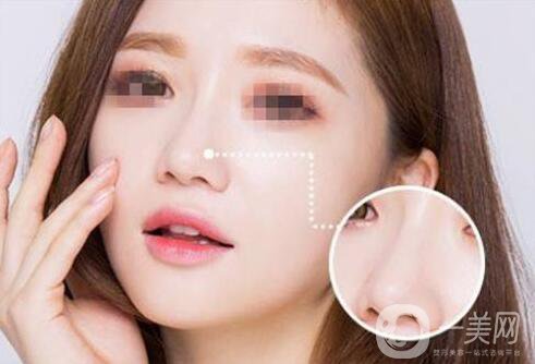 北京,自體脂肪隆鼻,多少錢