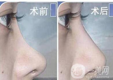 北京,自體脂肪隆鼻,多少錢