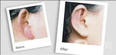 注射玻尿酸豐耳垂*果怎么樣？