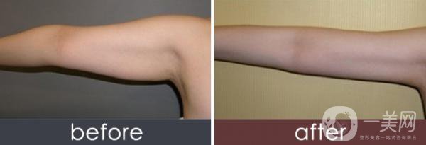 上臂吸脂多久看到*果 適用于哪些人群？