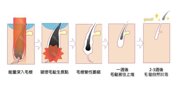 做一次激光脫毛的價(jià)格大概要多少錢？