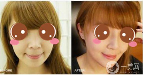 膨體聚四氟乙烯隆鼻*果怎么樣？