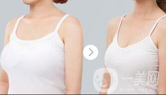 巨乳縮小術(shù)疤痕大嗎 巨乳縮小會(huì)留疤嗎