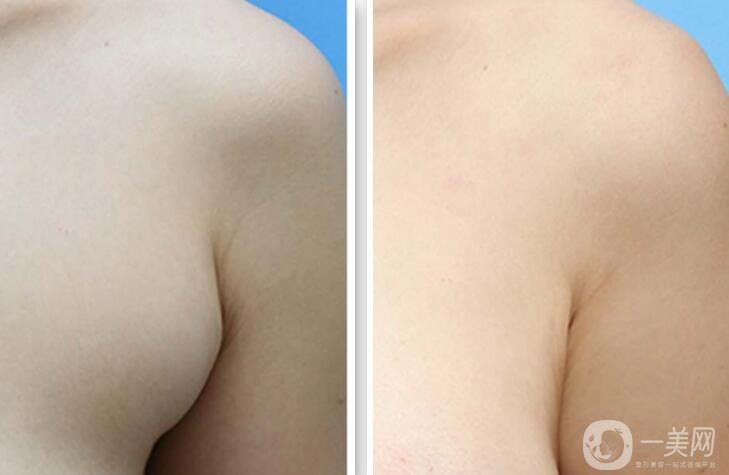 副乳吸脂幾天消腫 副乳吸脂術(shù)后多久恢復(fù)