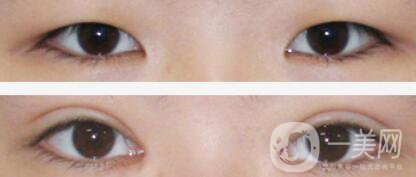 成都割雙眼皮價(jià)格是多少 做雙眼皮手術(shù)大概多少錢