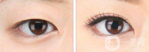 割雙眼皮整形醫(yī)院信息介紹 雙眼皮醫(yī)院如何選擇