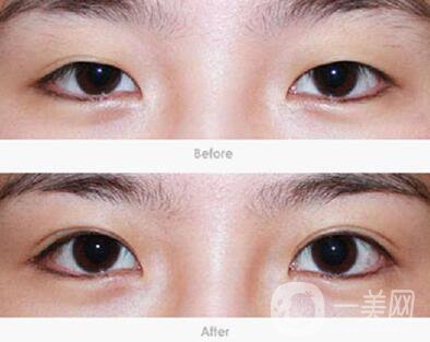 太原割雙眼皮介紹 太原做雙眼皮醫(yī)院