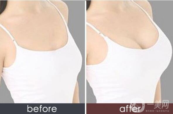 妙桃假體隆胸,價格