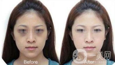 激光去黑眼圈副作用詳細(xì)介紹 去黑眼圈圖