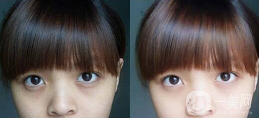 激光去黑眼圈副作用詳細(xì)介紹 去黑眼圈圖