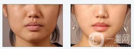 硅膠墊下巴是*的嗎 硅膠墊下巴可以維持多久