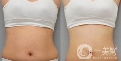 腰腹吸脂后多久變細 腰腹吸脂幾天恢復