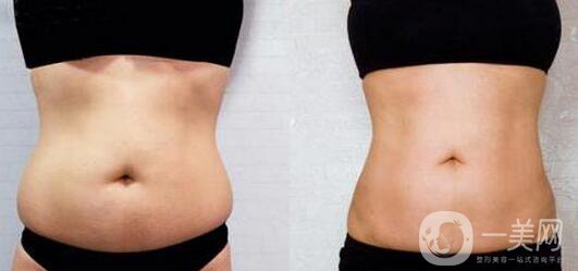 腰腹吸脂后多久變細 腰腹吸脂幾天恢復